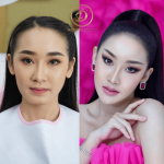 ฟิลเลอร์คาง-แอ้ม