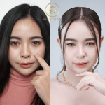 ฟิลเลอร์ใต้ตา-อาย